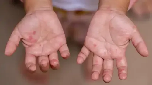 What are the Stages of Hand, Foot, and Mouth Disease (HFMD)?